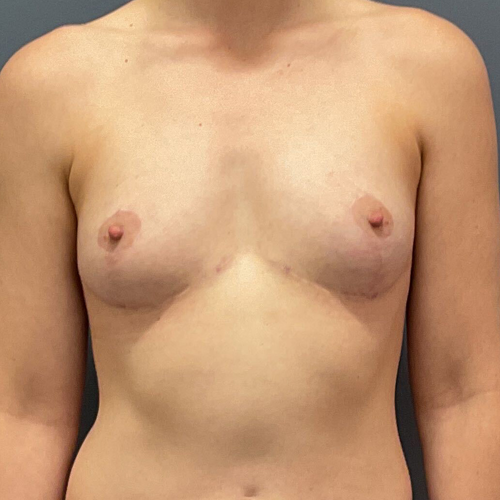 Case--8916 | After En Bloc + Lift (Mastopexy) 1