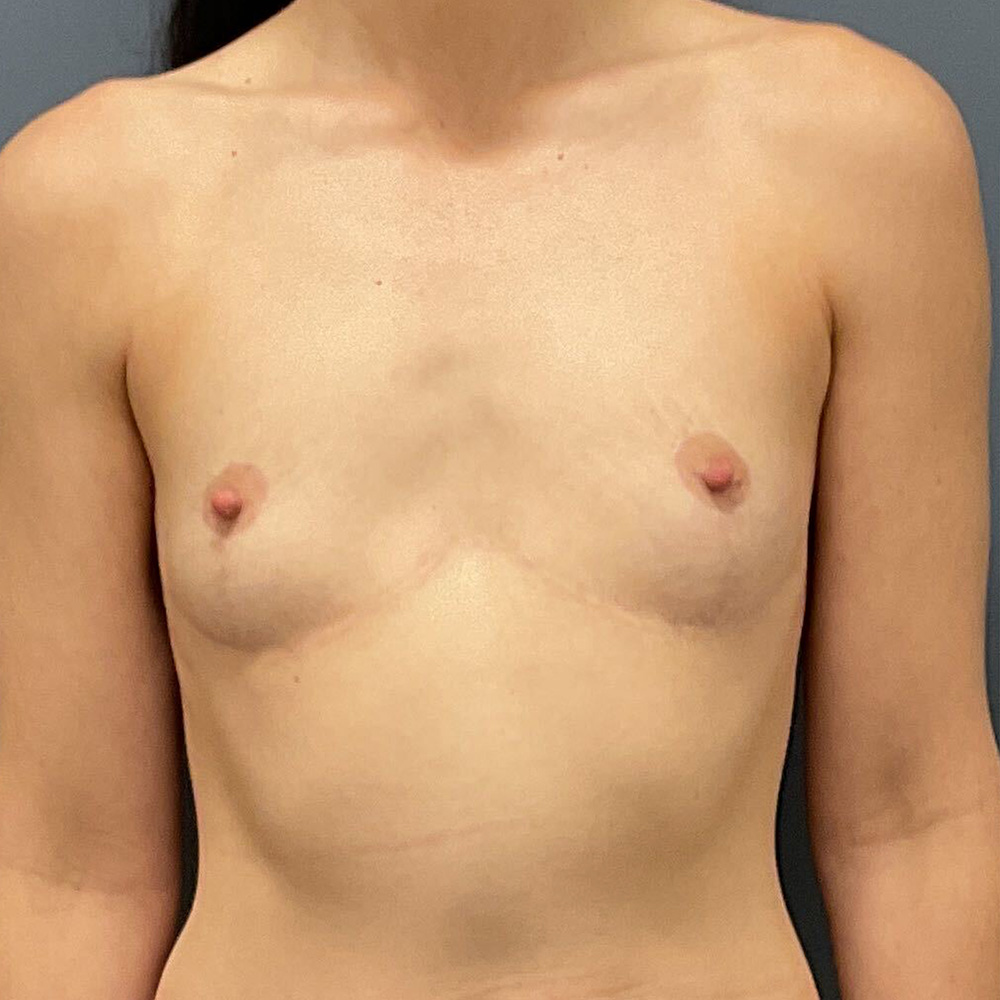 Case--8916 | Before En Bloc + Lift (Mastopexy) 1