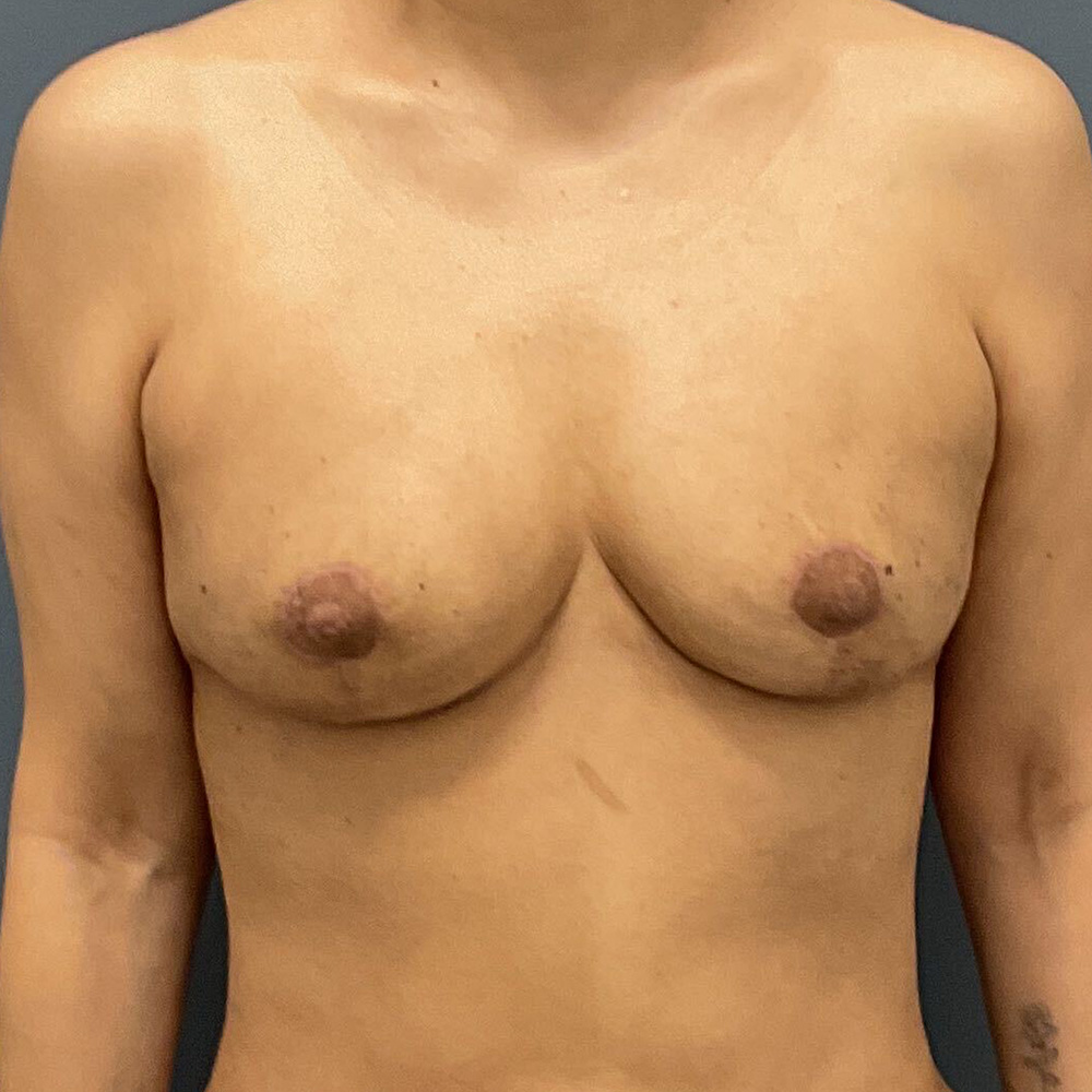 Case--8833 | After Full Correction Explant Surgery (En Bloc plus Fat Grafting w/ Lift) 1