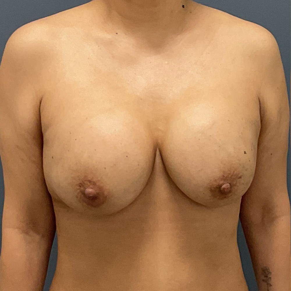 Case--8833 | Before Full Correction Explant Surgery (En Bloc plus Fat Grafting w/ Lift) 1