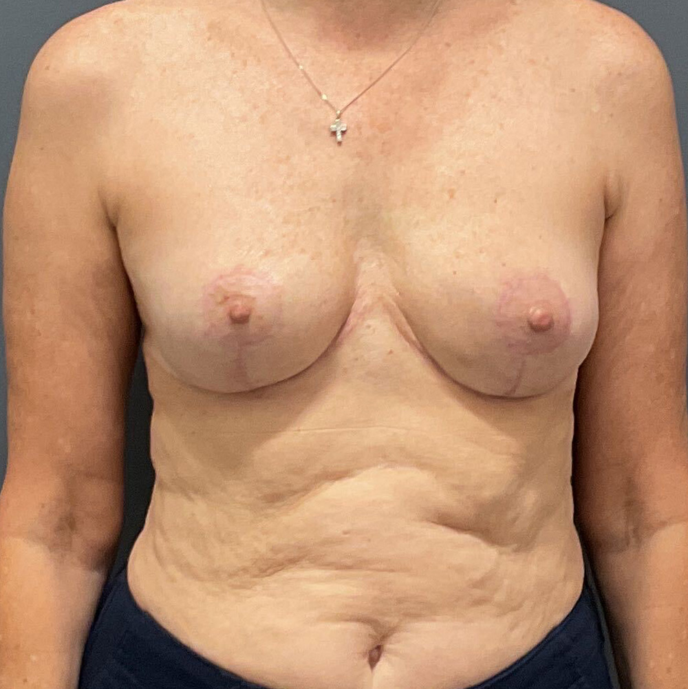 Case--2176 | After Full Correction Explant Surgery (En Bloc plus Fat Grafting w/ Lift) 1