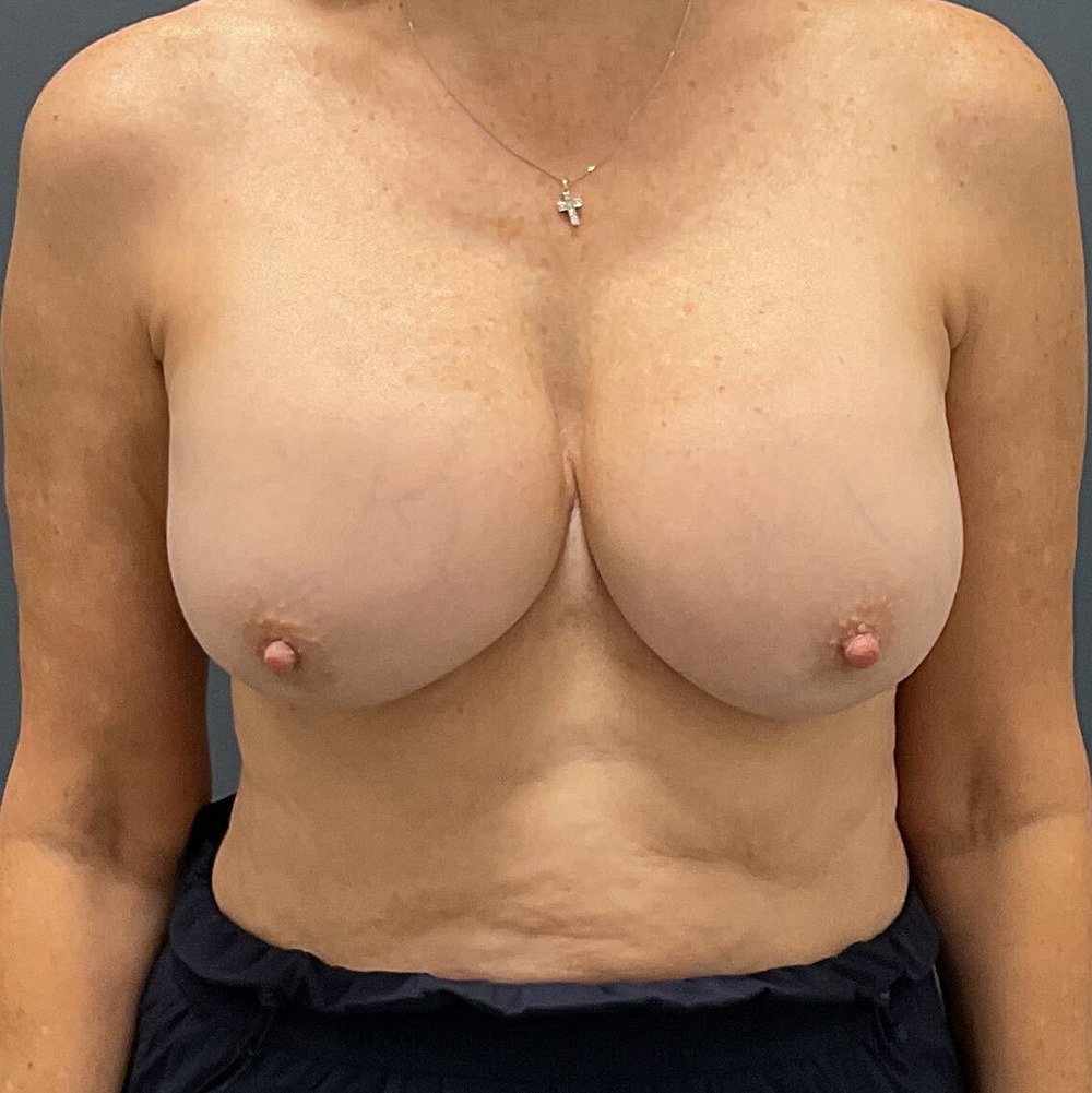 Case--2176 | Before Full Correction Explant Surgery (En Bloc plus Fat Grafting w/ Lift) 1