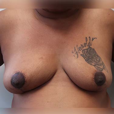 En-bloc---Lift-Only-Patient-17 | Before Explant