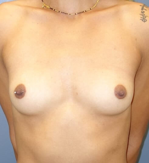 Breast-Augmentation-Patient-01 | Before Breast Augmentation
