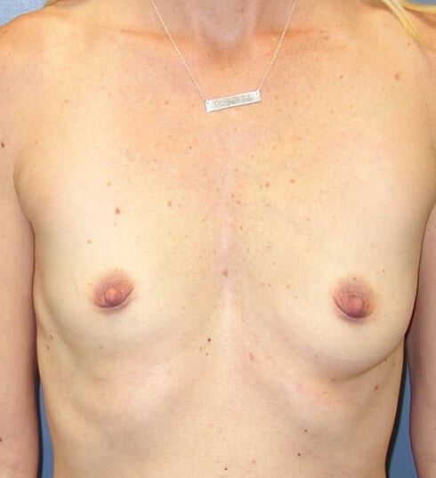 Breast-Augmentation-Patient-03 | Before Breast Augmentation