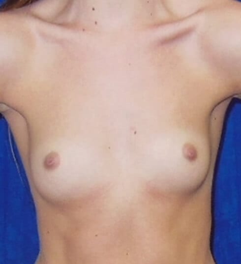 Breast-Augmentation-Patient-05 | Before Breast Augmentation