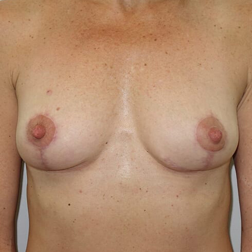 Breast-Lift-Patient-03 | After Breast Lift