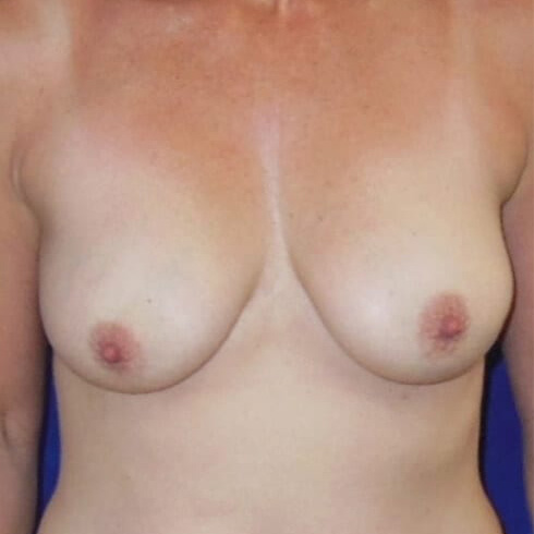 Breast-Lift-Patient-09 | Before Breast Lift