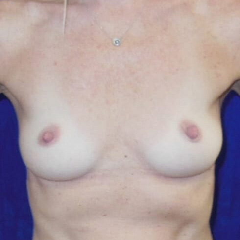 Breast-Reconstruction-Patient-01 | Before Breast Reconstruction
