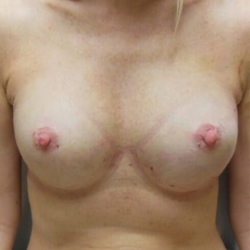 Breast-Reconstruction-Patient-01 | After Breast Reconstruction