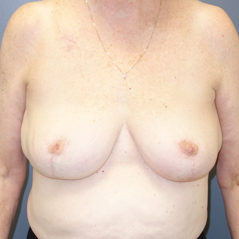Breast-Reconstruction-Patient-17 | After Breast Reconstruction