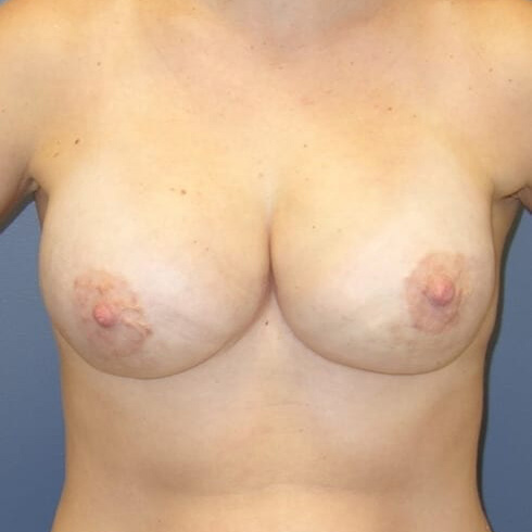 Breast-Reconstruction-Patient-03 | After Breast Reconstruction