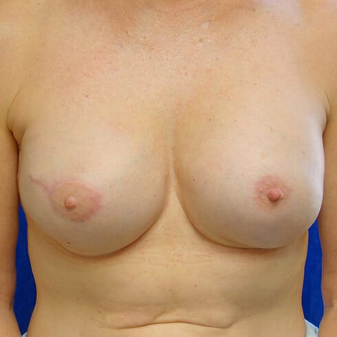Breast-Reconstruction-Patient-09 | After Breast Reconstruction