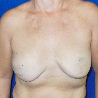 Breast-Reconstruction-Patient-19 | Before Breast Reconstruction