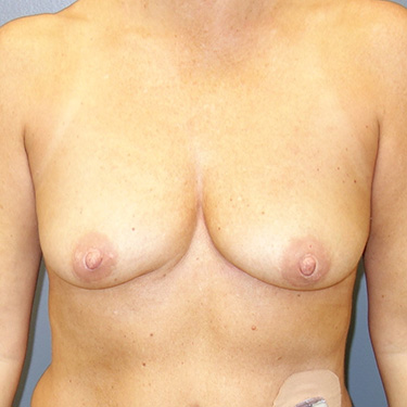 En-Bloc---Fat-Grafting-Only-Patient-05 | After En Bloc + Fat Grafting Only