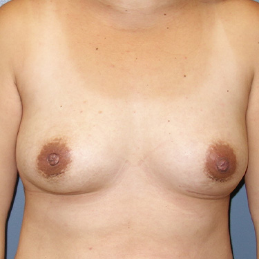 En-Bloc---Fat-Grafting-Only-Patient-06 | After En Bloc + Fat Grafting Only