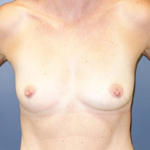 En-Bloc---Fat-Grafting-Only-Patient-04 | After En Bloc + Fat Grafting Only