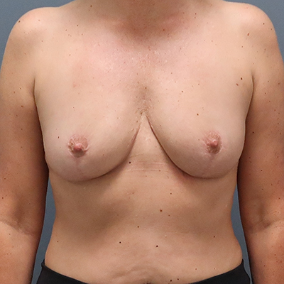 En-bloc---Lift-and-Fat-Grafting-Patient-18 | After Explant