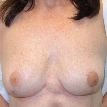 En-bloc---Lift-Only-Patient-16 | After Explant