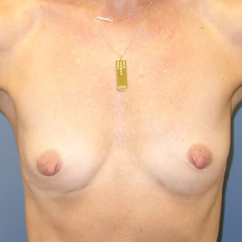 En-Bloc---Fat-Grafting-Only-Patient-01 | After En Bloc + Fat Grafting Only