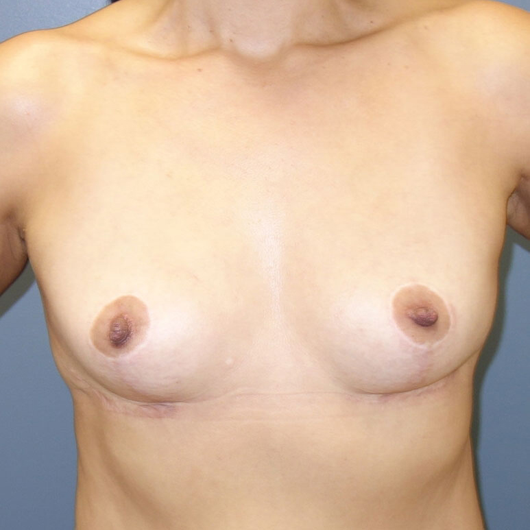 En-bloc---Lift-and-Fat-Grafting-Patient-10 | After Explant