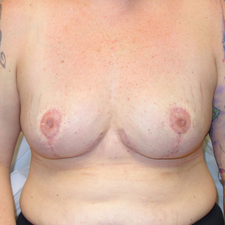 En-bloc---Lift-and-Fat-Grafting-Patient-11 | After Explant