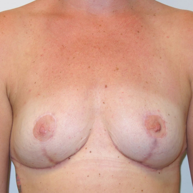 En-bloc---Lift-and-Fat-Grafting-Patient-12 | After Explant