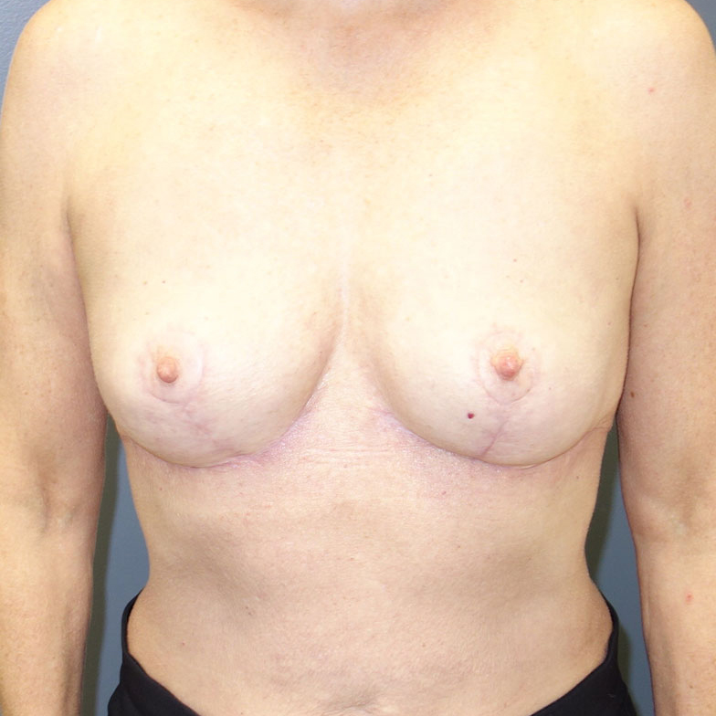 En-bloc---Lift-and-Fat-Grafting-Patient-14 | After Explant