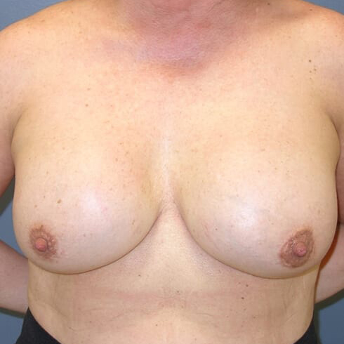 En-bloc---Lift-and-Fat-Grafting-Patient-06 | Before Explant