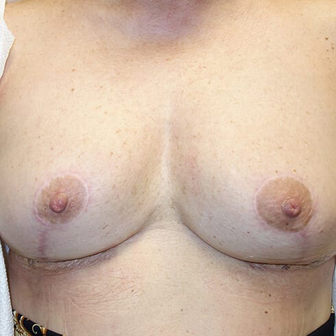 En-bloc---Lift-and-Fat-Grafting-Patient-06 | After Explant