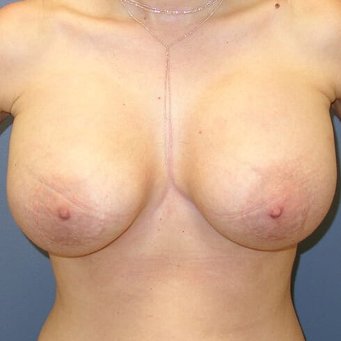 En-bloc---Lift-Only-Patient-01 | Before Explant