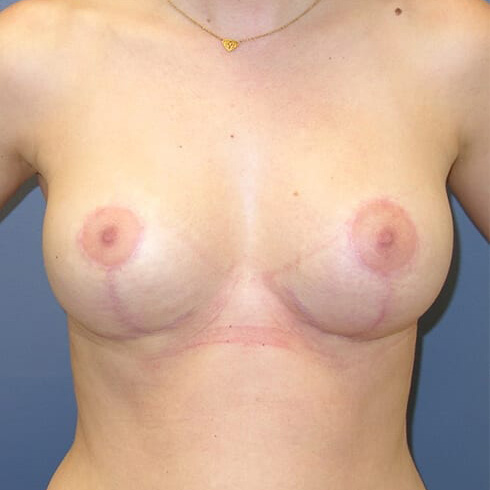 En-bloc---Lift-Only-Patient-01 | After Explant