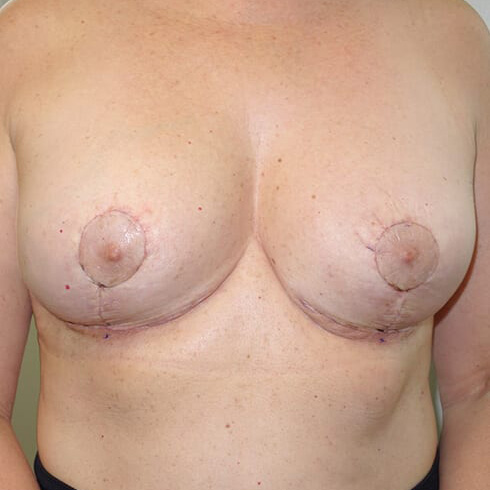 En-bloc---Lift-Only-Patient-05 | After Explant