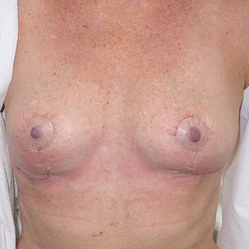 En-bloc---Lift-Only-Patient-06 | After Explant