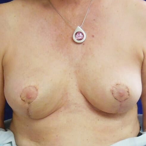 En-bloc---Lift-Only-Patient-08 | After Explant