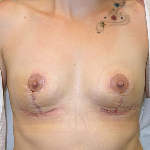 En-bloc---Lift-Only-Patient-09 | After Explant