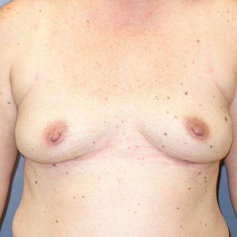 En-bloc-Only-Patient-01 | After Explant