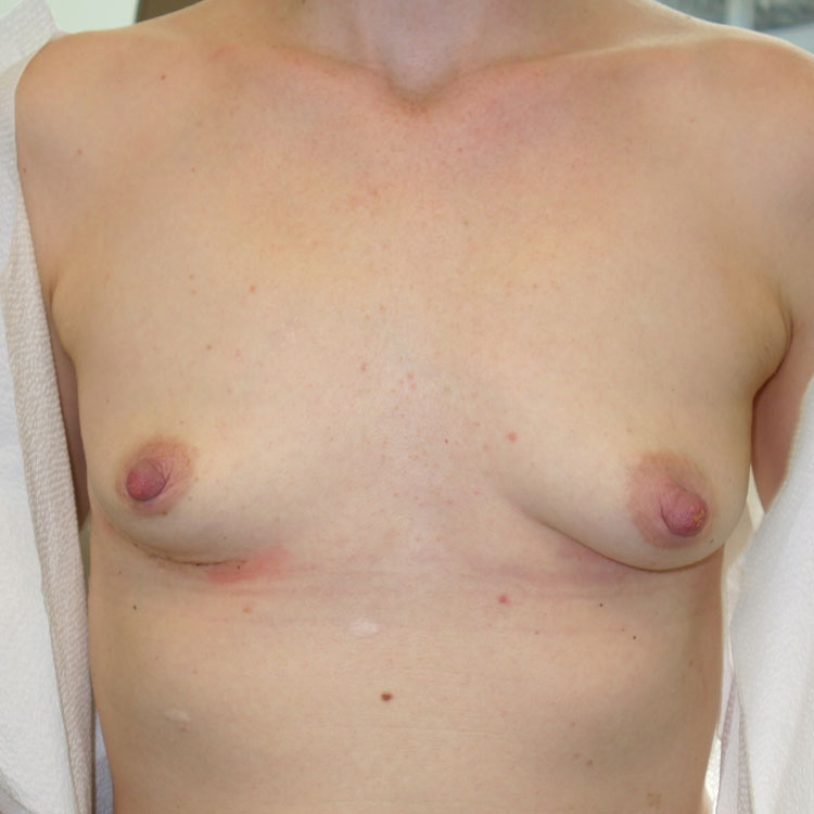 En-bloc-Only-Patient-11 | After En Bloc Only