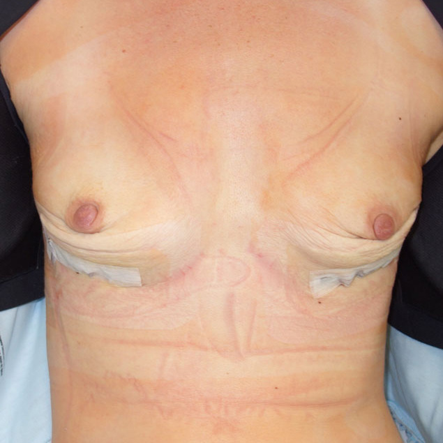 En-bloc-Only-Patient-12 | After En Bloc Only