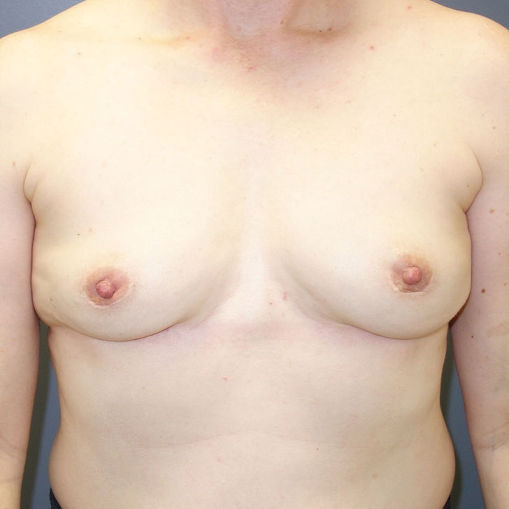 En-bloc-Only-Patient-14 | After En Bloc Only