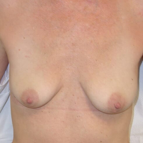 En-bloc-Only-Patient-05 | After Explant