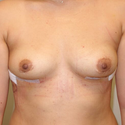 En-bloc-Only-Patient-06 | After Explant