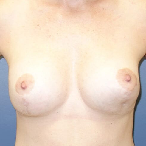 En-bloc-Only-Patient-07 | Before Explant