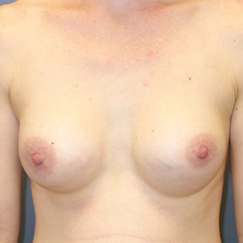 En-bloc-Only-Patient-08 | Before En Bloc Only