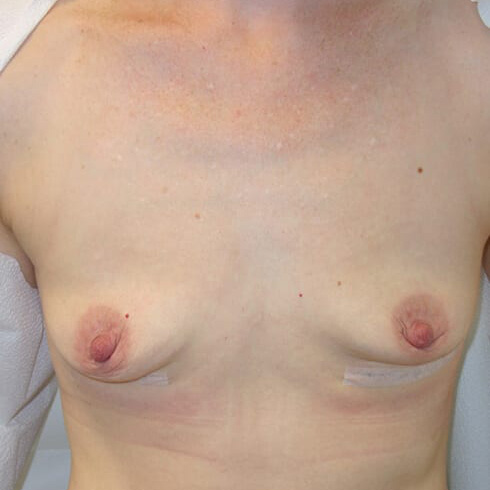 En-bloc-Only-Patient-08 | After En Bloc Only