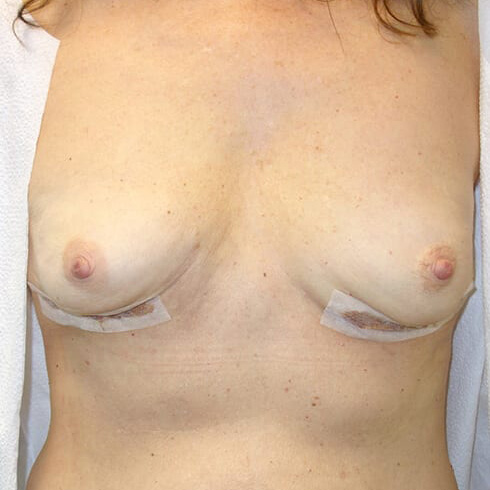 En-bloc-Only-Patient-09 | After En Bloc Only