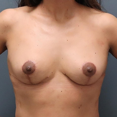 En-bloc---Lift-and-Fat-Grafting-Patient-16 | After Explant