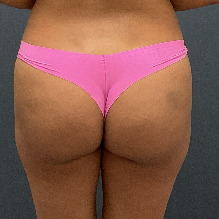 Fat-Grafting-Patient-13 | Before Fat Grafting 2
