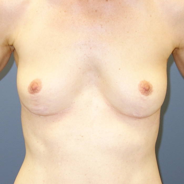 Natural Breast Augmentation - Before 2