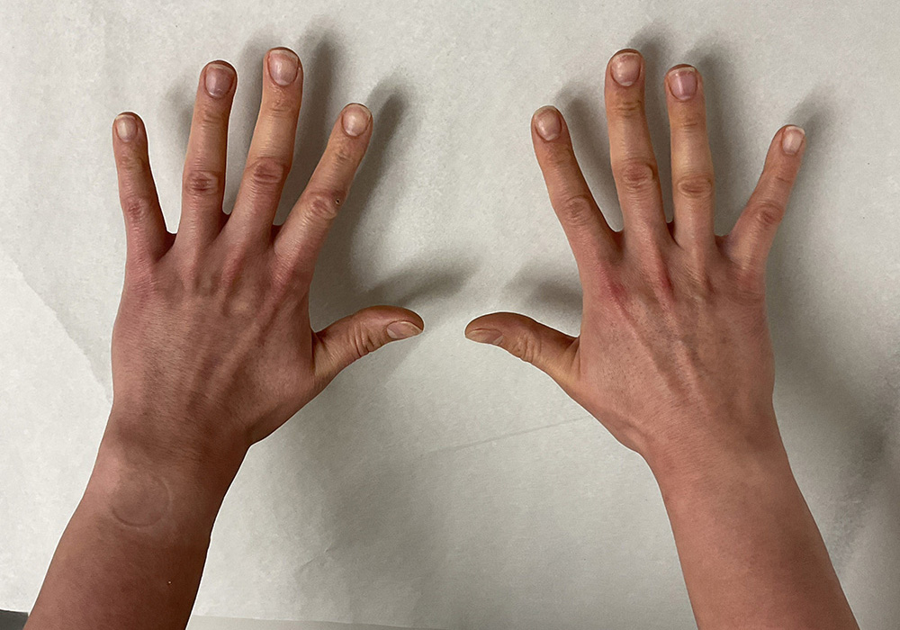 Case--6158 | Before Fat Transfer